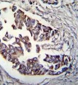 IHC-P analysis of human breast carcinoma using GTX50884 Rad9 (phospho Ser387) antibody.