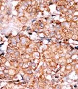 IHC-P analysis of human breast carcinoma using GTX50885 Rad9 (phospho Ser328) antibody.