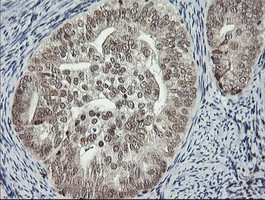 IHC-P analysis of human endometrium adenocarcinoma tissue using GTX50967 MCTS1 antibody [2G2]. Antigen retrieval : Heat-induced epitope retrieval by 10mM citrate buffer, pH6.0, 120oC for 3min.