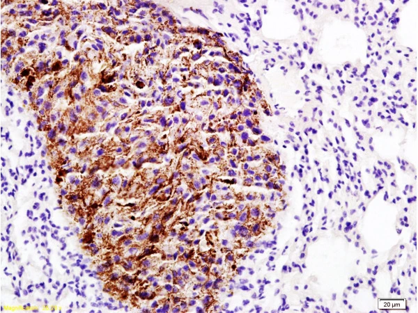 IHC-P analysis of rat lung carcinoma tissue using GTX50979 Emp1 antibody. Dilution : 1:200