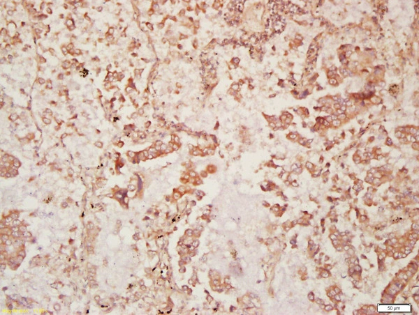 IHC-P analysis of human lung carcinoma tissue using GTX51129 DISP2 antibody. Dilution : 1:200 IHC-P analysis of human lung carcinoma tissue using GTX51129 DISP2 antibody. Dilution : 1:200