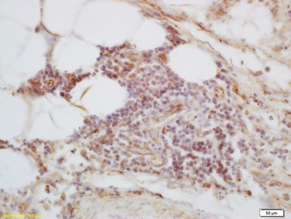 IHC-P analysis of human lung carcinoma tissue using GTX51386 C1orf106 antibody. Dilution : 1:200 IHC-P analysis of human lung carcinoma tissue using GTX51386 C1orf106 antibody. Dilution : 1:200