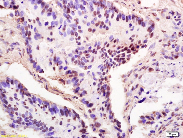 IHC-P analysis of human colon carcinoma tissue using GTX51521 THOC2 antibody. Dilution : 1:200 IHC-P analysis of human colon carcinoma tissue using GTX51521 THOC2 antibody. Dilution : 1:200