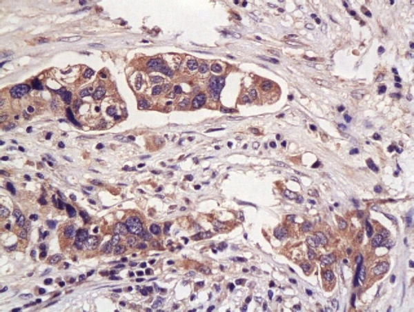 IHC-P analysis of human endometrial carcinoma tissue using GTX51524 Haptoglobin antibody. Dilution : 1:200 IHC-P analysis of human endometrial carcinoma tissue using GTX51524 Haptoglobin antibody. Dilution : 1:200