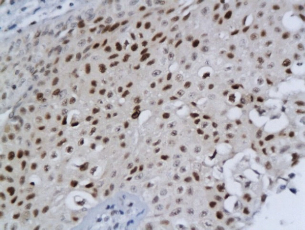 IHC-P analysis of human bladder cancer tissue using GTX51553 DBC1 antibody.