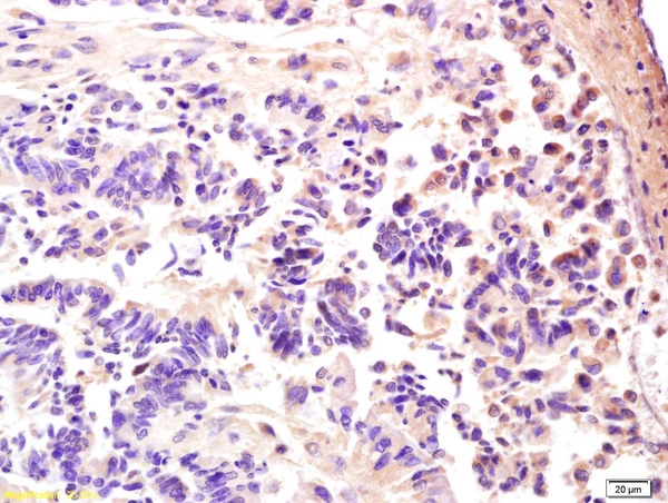 IHC-P analysis of human rectal carcinoma tissue using GTX51582 AMPK gamma 3 antibody. Dilution : 1:200