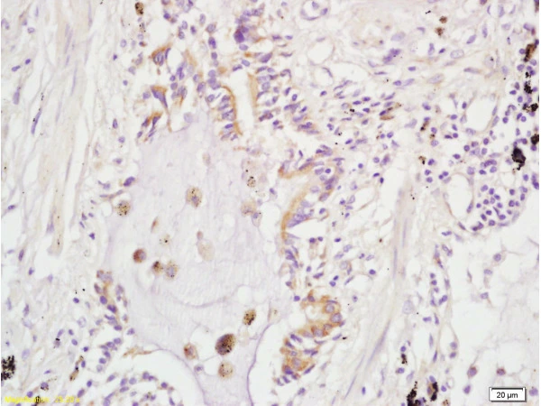 IHC-P analysis of human lung carcinoma tissue using GTX51654 ARHGAP24 antibody. Dilution : 1:200 IHC-P analysis of human lung carcinoma tissue using GTX51654 ARHGAP24 antibody. Dilution : 1:200