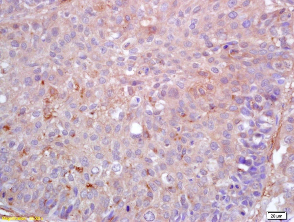 IHC-P analysis of human lung carcinoma tissue using GTX51779 DCHS1 antibody. Dilution : 1:200