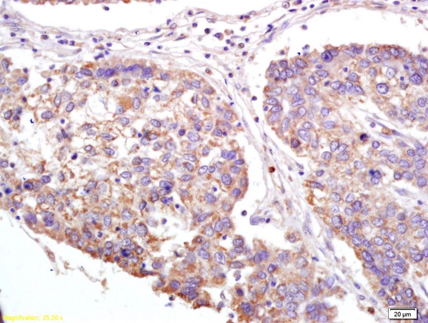 IHC-P analysis of human lung carcinoma tissue using GTX51780 XAGE2 antibody. Dilution : 1:200 IHC-P analysis of human lung carcinoma tissue using GTX51780 XAGE2 antibody. Dilution : 1:200