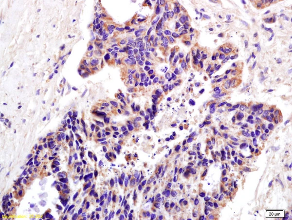 IHC-P analysis of human colon carcinoma tissue using GTX51780 XAGE2 antibody. Dilution : 1:200