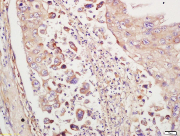 IHC-P analysis of human lung carcinoma tissue using GTX51836 TTK antibody. Dilution : 1:200 IHC-P analysis of human lung carcinoma tissue using GTX51836 TTK antibody. Dilution : 1:200