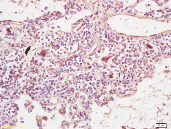IHC-P analysis of human lung carcinoma tissue using GTX51868 PLEKHM2 antibody. Dilution : 1:200