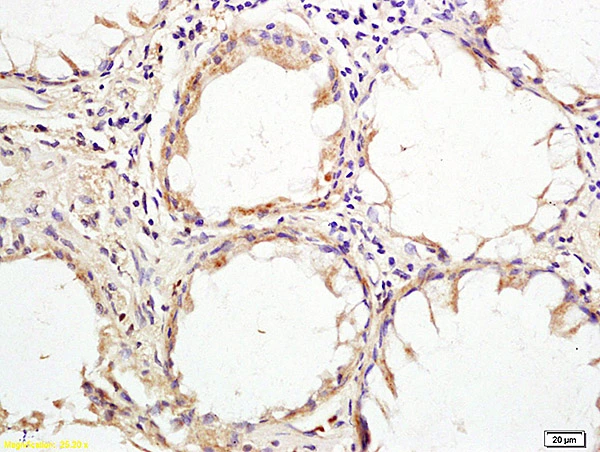 IHC-P analysis of human rectal carcinoma tissue using GTX51981 HHLA2 antibody. Dilution : 1:200 IHC-P analysis of human rectal carcinoma tissue using GTX51981 HHLA2 antibody. Dilution : 1:200