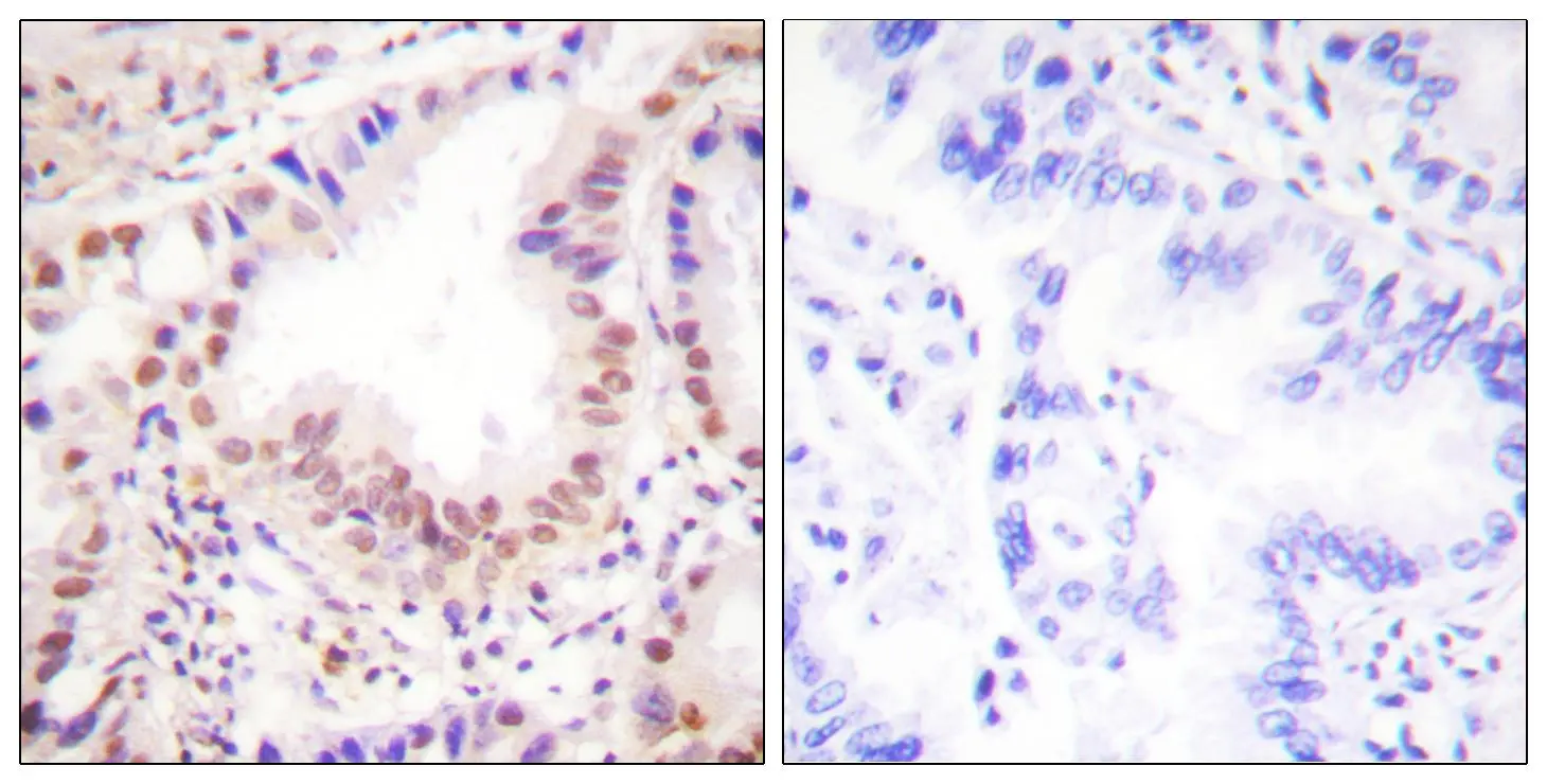 IHC-P analysis of human lung carcinoma tissue using GTX52308 ETS1 antibody. The picture on the right is blocked with the synthesized peptide.