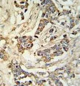 IHC-P analysis of human breast carcinoma using GTX53669 MRAP antibody.