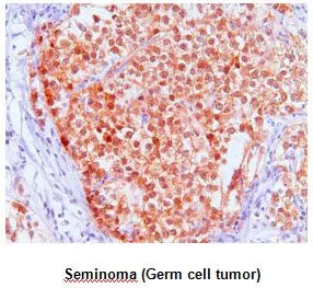 IHC-P analysis ofof Seminoma (Germ cell tumor) tissue using FKBP4 antibody at a dilution of 1:50. IHC-P analysis ofof Seminoma (Germ cell tumor) tissue using FKBP4 antibody at a dilution of 1:50.