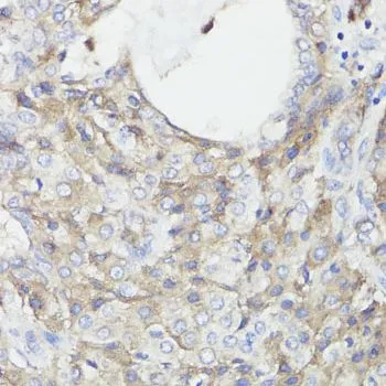 IHC-P analysis of human lung cancer tissue using GTX53909 CD59 antibody. Dilution : 1:100