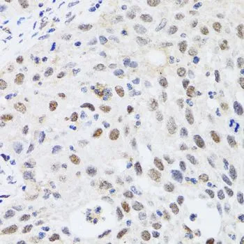 IHC-P analysis of human lung cancer tissue using GTX53928 CBX4 antibody. Dilution : 1:100
