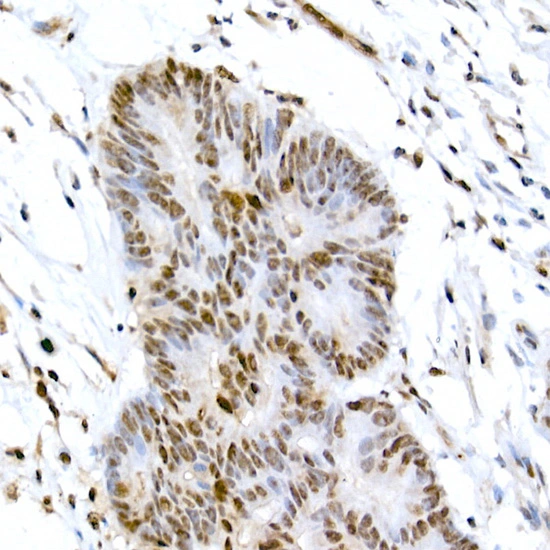IHC-P analysis of human colon carcinoma tissue using GTX53975 CREB (phospho Ser133) antibody. Antigen retrieval : High pressure antigen retrieval with 10 mM citrate buffer (pH 6) Dilution : 1:200