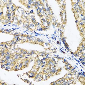 IHC-P analysis of human gastric cancer tissue using GTX54005 EPB41 antibody. Dilution : 1:100