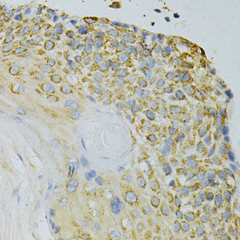IHC-P analysis of human esophageal cancer tissue using GTX54095 GPX4 antibody. Dilution : 1:200