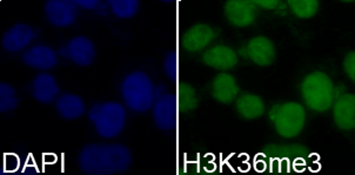 IHC-P analysis of human lung cancer tissue using GTX54109 Histone H3K36me3 (tri-methyl Lys36) antibody. Dilution : 1:200