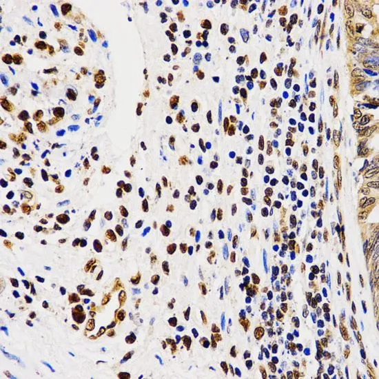 IHC-P analysis of human rectal cancer tissue using GTX54116 Histone H4R3me2 (di-methyl Arg3) antibody. Dilution : 1:200