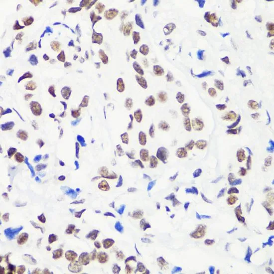 IHC-P analysis of human breast cancer tissue using GTX54135 Histone H3R8me1 (mono-methyl Arg8) antibody. Dilution : 1:100