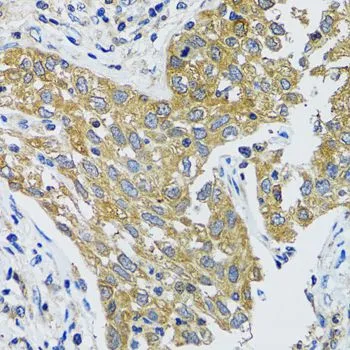 IHC-P analysis of human lung cancer tissue using GTX54155 GOT1 antibody. Dilution : 1:100