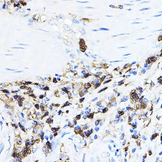 IHC-P analysis of human esophageal cancer tissue using GTX54287 Lck antibody. Dilution : 1:100