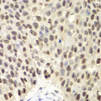 IHC-P analysis of human lung cancer tissue using GTX54353 MCM6 antibody. Dilution : 1:100