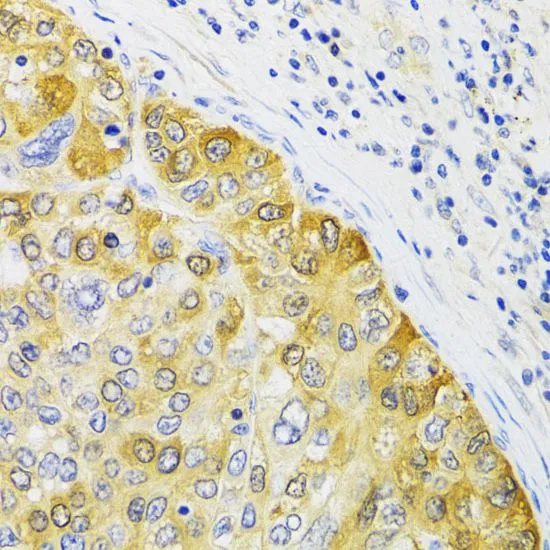 IHC-P analysis of human liver cancer tissue using GTX54589 EBP1 antibody. Dilution : 1:100