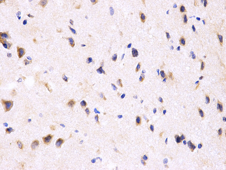 IHC-P analysis of human kidney cancer tissue using GTX54592 PPP2R4 antibody. Dilution : 1:200