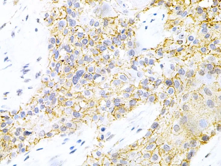 IHC-P analysis of human esophageal cancer tissue using GTX54592 PPP2R4 antibody. Dilution : 1:200