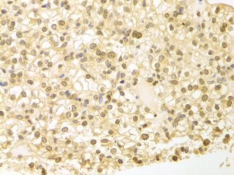 IHC-P analysis of human kidney cancer tissue using GTX54594 PLCB1 antibody. Dilution : 1:100