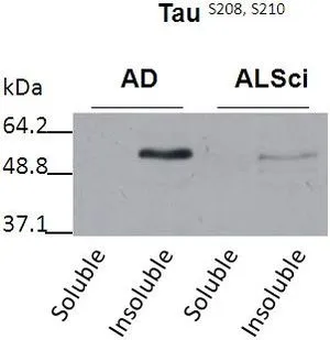 WB analysis of soluble and insoluble fractions in samples isolated from patients with a neurodegenerative disease using Tau (phospho Ser208/210) antibody (AD: Alzheimers disease. ALSci: Amyotropic lateral sclerosis).