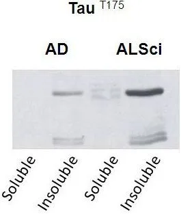 WB analysis of soluble and insoluble fractions in samples isolated from patients with a neurodegenerative disease using Tau (phospho Thr175) antibody (AD: Alzheimers disease. ALSci: Amyotropic lateral sclerosis).