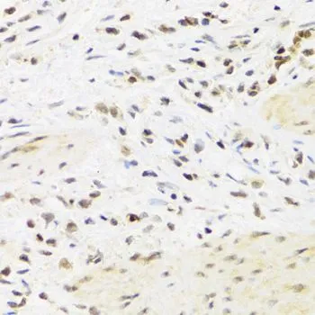 IHC-P analysis of human breast cancer tissue using GTX54685 SUMO4 antibody. Dilution : 1:100