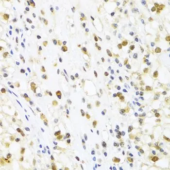 IHC-P analysis of human kidney cancer tissue using GTX54685 SUMO4 antibody. Dilution : 1:100