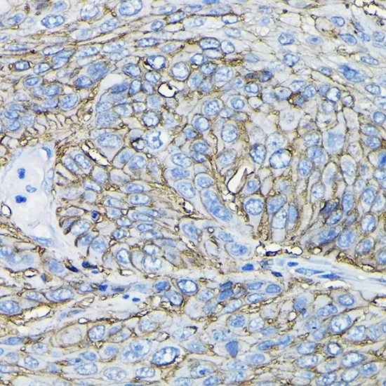 IHC-P analysis of human esophageal cancer tissue using GTX54716 CD98 antibody. Dilution : 1:100