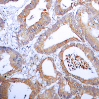 IHC-P analysis of formalin fixed human colon cancer tissue section using GTX54911 AKR1B1 antibody. Antigen retrieval : Heat mediated antigen retrieval with sodium citrate buffer (pH 6.0)