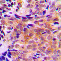 IHC-P analysis of formalin fixed human breast cancer tissue section using GTX54912 ACOT2 antibody. Antigen retrieval : Heat mediated antigen retrieval with sodium citrate buffer (pH 6.0)