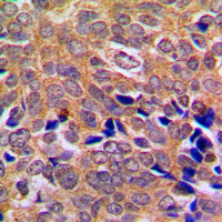 IHC-P analysis of formalin fixed human breast cancer tissue section using GTX54914 ABL antibody. Antigen retrieval : Heat mediated antigen retrieval with sodium citrate buffer (pH 6.0)