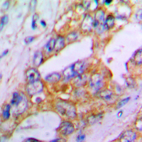 IHC-P analysis of formalin fixed human lung cancer tissue section using GTX54920 Aggrecan antibody. Antigen retrieval : Heat mediated antigen retrieval with sodium citrate buffer (pH 6.0)
