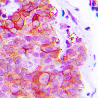 IHC-P analysis of formalin fixed human breast cancer tissue section using GTX54924 alpha 2c Adrenergic Receptor antibody. Antigen retrieval : Heat mediated antigen retrieval with sodium citrate buffer (pH 6.0)