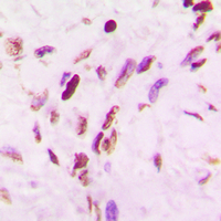 IHC-P analysis of formalin fixed human lung cancer tissue section using GTX54949 p53 (Acetyl Lys319) antibody. Antigen retrieval : Heat mediated antigen retrieval with sodium citrate buffer (pH 6.0)
