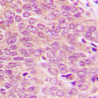 IHC-P analysis of formalin fixed human breast cancer tissue section using GTX54960 PBK (phospho Thr9) antibody. Antigen retrieval : Heat mediated antigen retrieval with sodium citrate buffer (pH 6.0)