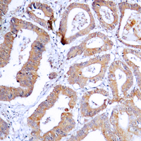 IHC-P analysis of formalin fixed human colon cancer tissue section using GTX54968 MEK1/2 (phospho Ser218/Ser222) antibody. Antigen retrieval : Heat mediated antigen retrieval with sodium citrate buffer (pH 6.0)
