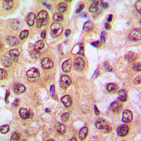 IHC-P analysis of formalin fixed human prostate cancer tissue section using GTX54979 PTEN (phospho Ser370) antibody. Antigen retrieval : Heat mediated antigen retrieval with sodium citrate buffer (pH 6.0)