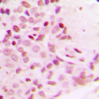 IHC-P analysis of formalin fixed human breast cancer tissue section using GTX54982 NFkB p65 (phospho Thr254) antibody. Antigen retrieval : Heat mediated antigen retrieval with sodium citrate buffer (pH 6.0) IHC-P analysis of formalin fixed human breast cancer tissue section using GTX54982 NFkB p65 (phospho Thr254) antibody. Antigen retrieval : Heat mediated antigen retrieval with sodium citrate buffer (pH 6.0)